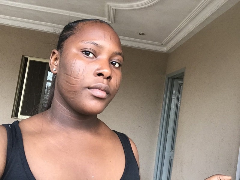 Silicon Gel Scar/Tribal Mark/Keloid Silicone Gel Flattener in Surulere -  Skincare, Knew Nigeria